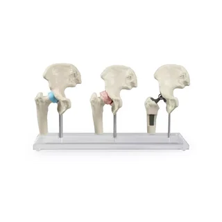 Lonkkaimplanttimalli