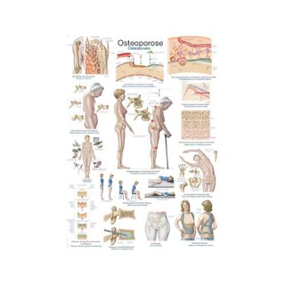 Juliste Osteoporoosi, Anatominen juliste 50x70cm