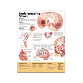 Understanding Stroke English Laminated (Understanding Stroke)