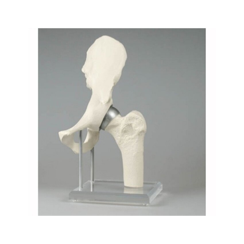 Lonkkanivelmalli implantilla, Birmingham Hip